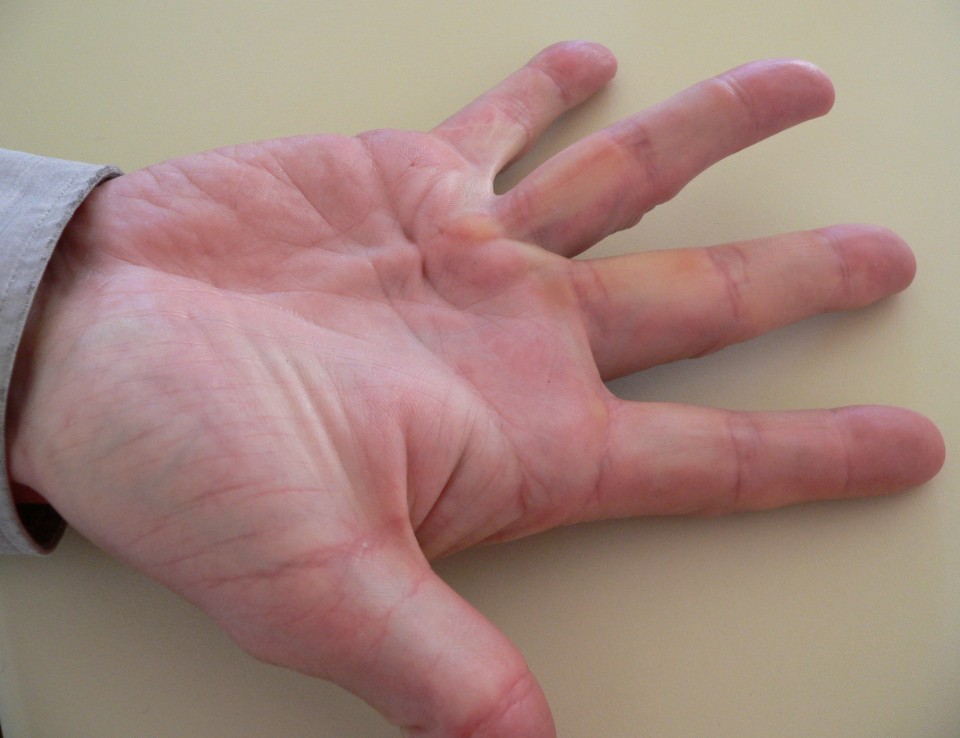 choroba dupuytrena operacja uwolnienie przykurczu palców szpital 1 dayclinic gdańsk gdynia sopot