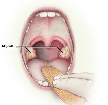 Przerośnięte migdałki podniebienne szpital 1daycninic gdańsk gdynia sopot trójmiasto operacja