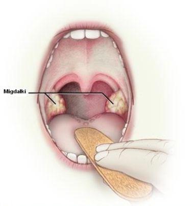 Przerośnięte migdałki podniebienne szpital 1daycninic gdańsk gdynia sopot trójmiasto operacja