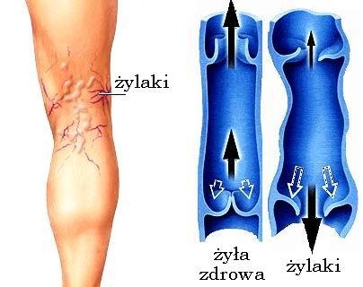 operacyjne leczenie żylaków kończyn dolnych operacja gdańsk szpital 1dayclinic etermed trójmiasto