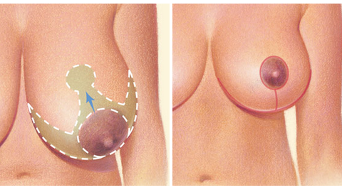pomniejszenie piersi gigantomastia szpita; 1dayclinic etermed gdańsk