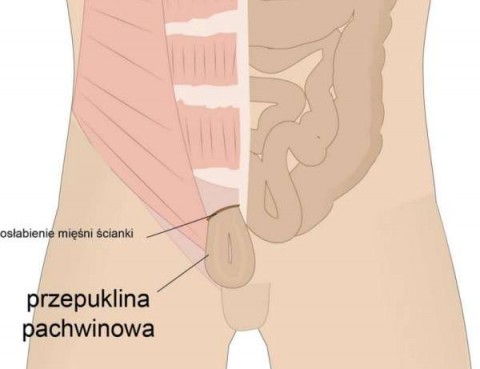 przepuklina pachwinowa szpital 1dayclinic gdańsk