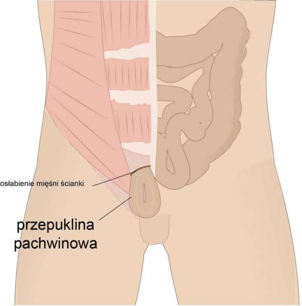 przepuklina pachwinowa szpital 1dayclinic gdańsk