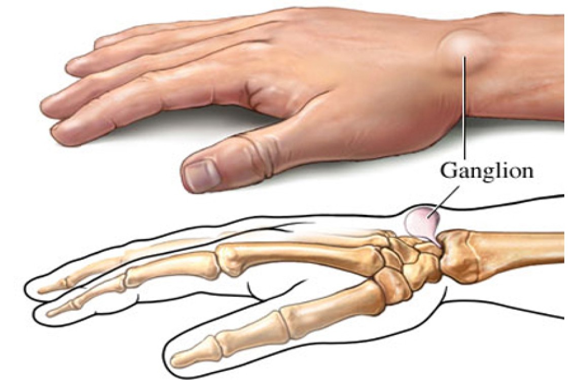 ganglion,czyli bolesny guzek - zabiegi na tkankach miękkich usunięcie ganglionu