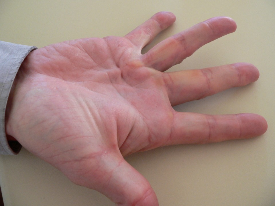 choroba dupuytrena operacja uwolnienie przykurczu palców szpital 1 dayclinic gdańsk gdynia sopot