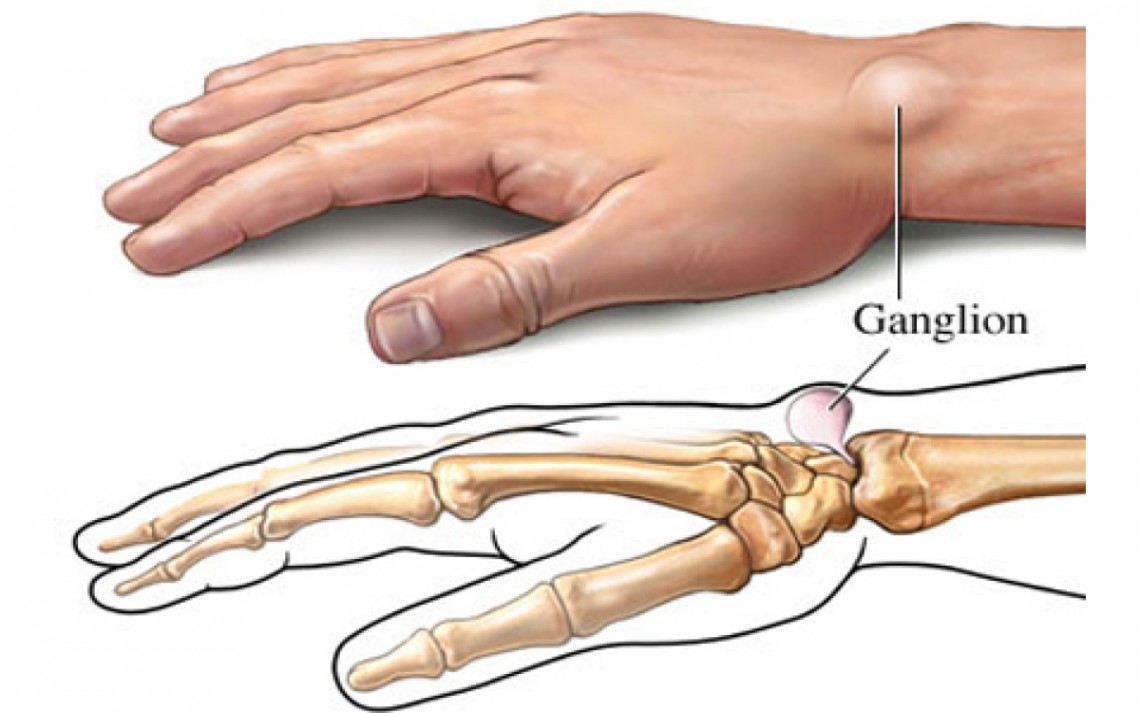 ganglion,czyli bolesny guzek - zabiegi na tkankach miękkich usunięcie ganglionu