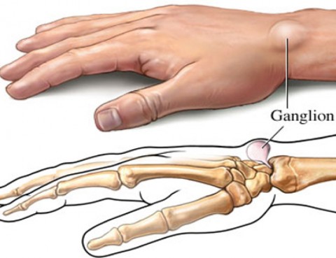 ganglion,czyli bolesny guzek - zabiegi na tkankach miękkich usunięcie ganglionu